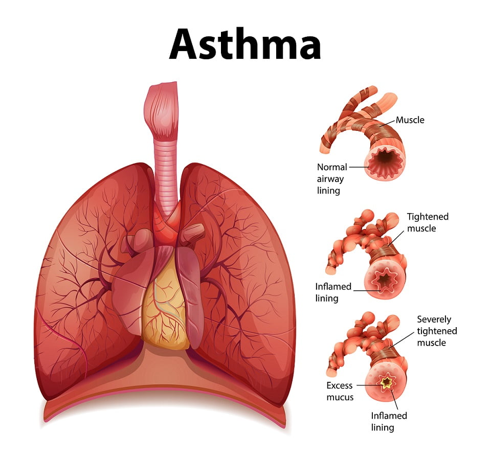 Comparison of healthy lung and Asthmatic lung