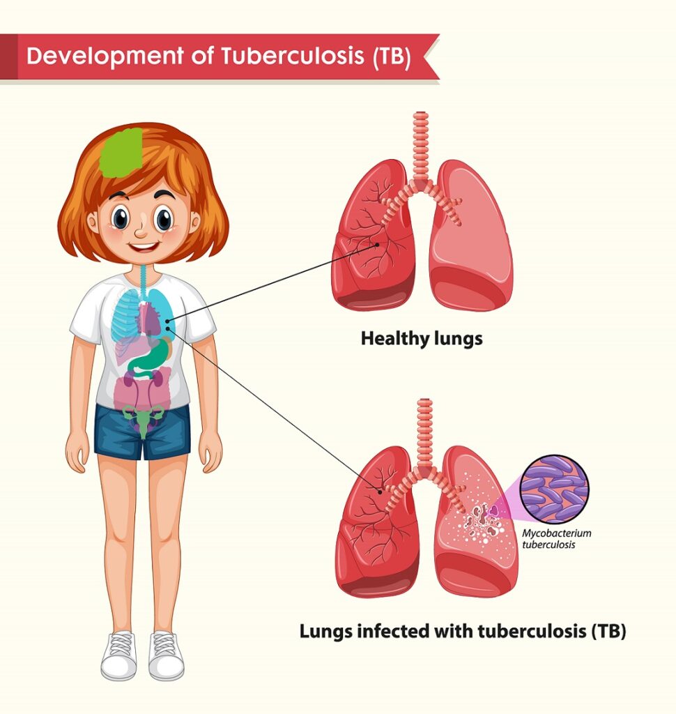 Scientific medical illustration of tuberculosis illustration